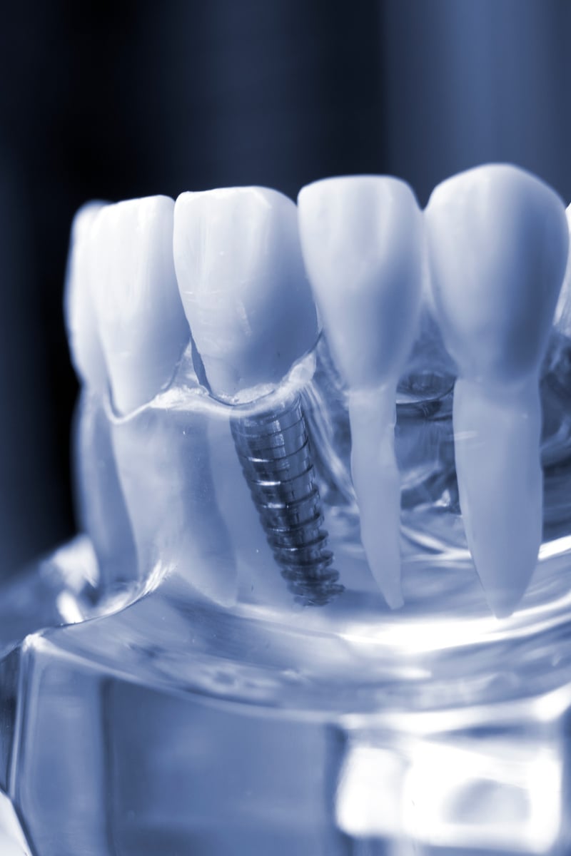 Dentist Dental Teeth Implant